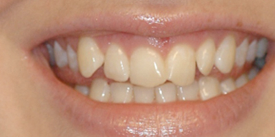 Align Bleach and Bond