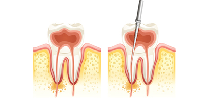 Root Canal Treatment