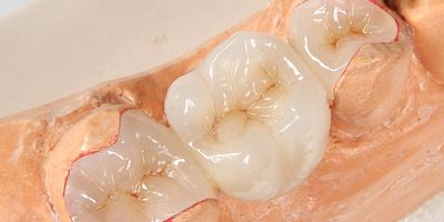 Dental White Fillings