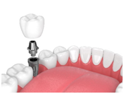 Dental implants – still not convinced?