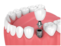 Dental implants look and feel like your natural teeth