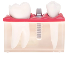 Dental implants