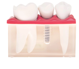Dental implants