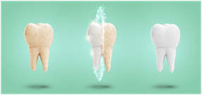 Teeth Whitening