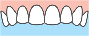 Benefits of Veneers