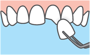Veneers