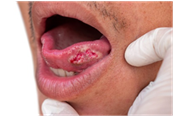 Mouth cancer november 3
