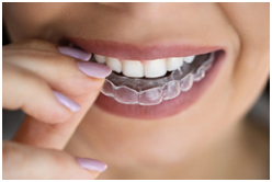 Invisalign