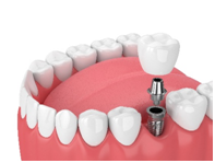 dental implants