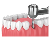 denture