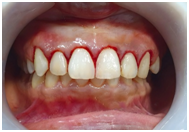 Gum disease