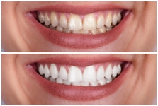 Teeth Whitening